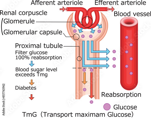 腎小体　糖尿　イラスト　英語 photo