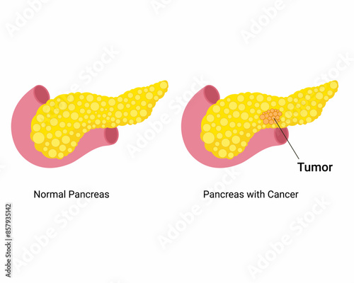 normal and pancreas with cancer human internal organ anatomy tumor demonstrated on pancreas