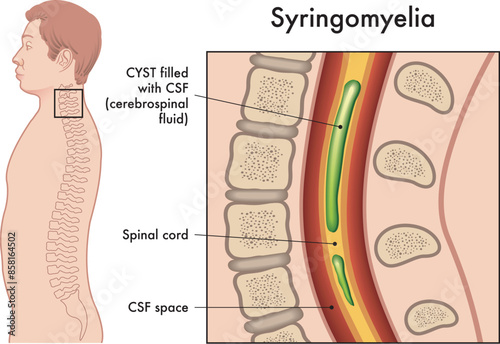 Medical illustration shows the symptoms of Syringomyelia, a pathology that affects the spine.