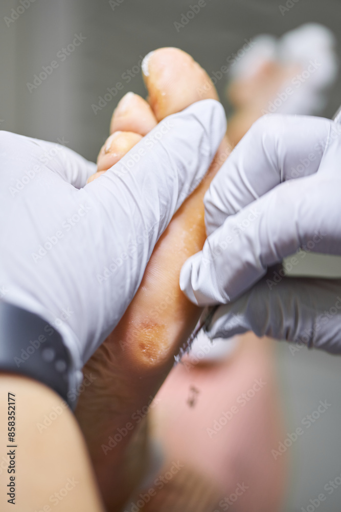 Podiatry. Removing calluses with a scalpel at the beautician Podiatry. Removing calluses with a scalpel at the beautician