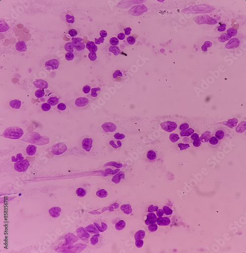 Microscopic image showing Chronic myeloid leukaemia (CML) is a type of cancer, all stage of granulocytic maturation is noted, CML in chronic phase. ALL. photo