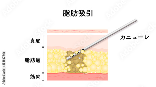 脂肪吸引_カニューレ