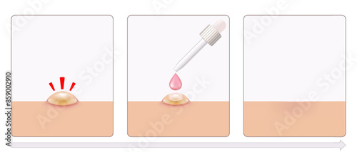 Steps for using acne treatment creams, gels, and acne lotions. Skin layers before, during and after treatment. 