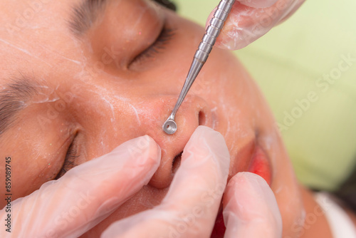 Close-up of a person receiving a facial comedone extraction treatment at an aesthetic clinic, focusing on skin care and hygiene. photo