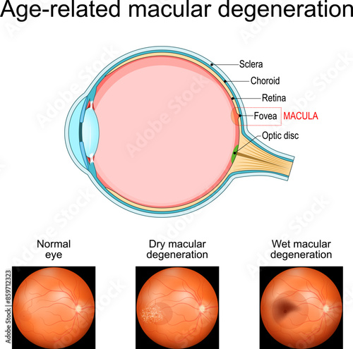 Age-related macular degeneration. Cross section of human eye