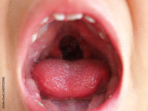 Fotografie Child girl showing an uvula in a cleft palate