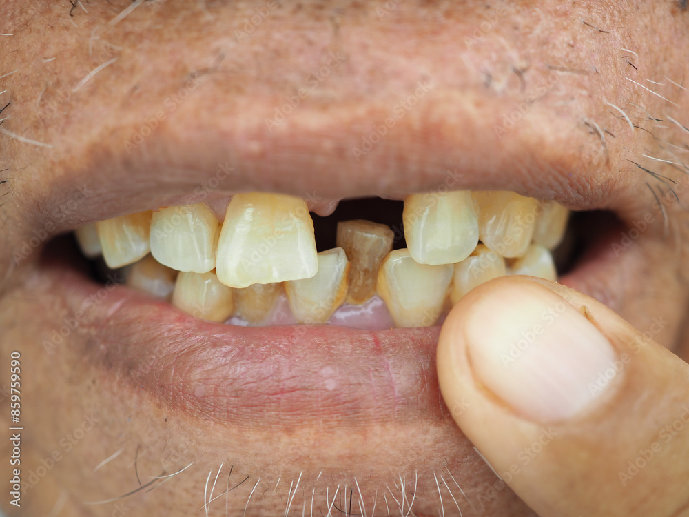 Obraz premium Plaque on teeth human teeth after smoking. Smoking harm concept. Closeup photo, blurred.