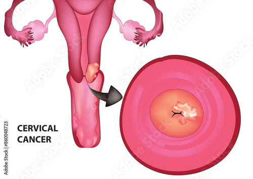 Cervical cancer is a type of cancer that begins in the cells lining the cervix, which is the lower part of the uterus (womb) that connects to the vagina.