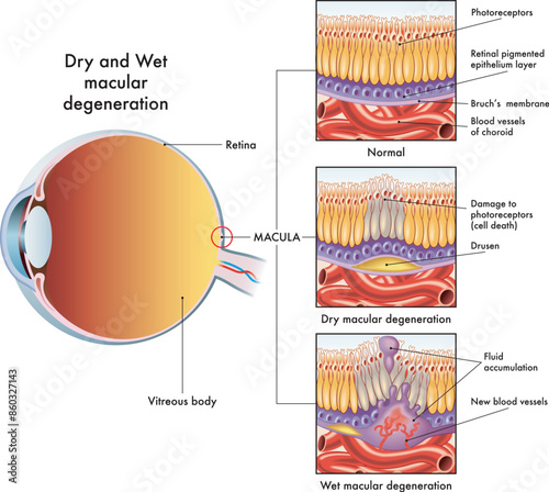 Medical illustration shows the symptoms affecting an eye affected by dry and wet maculopathy, with annotations.