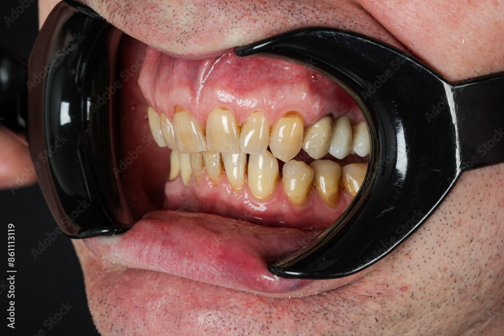 Obraz premium Wedge-shaped (cone-shaped) section of enamel loss in the area of the tooth neck. Destruction of the hard part of the tooth