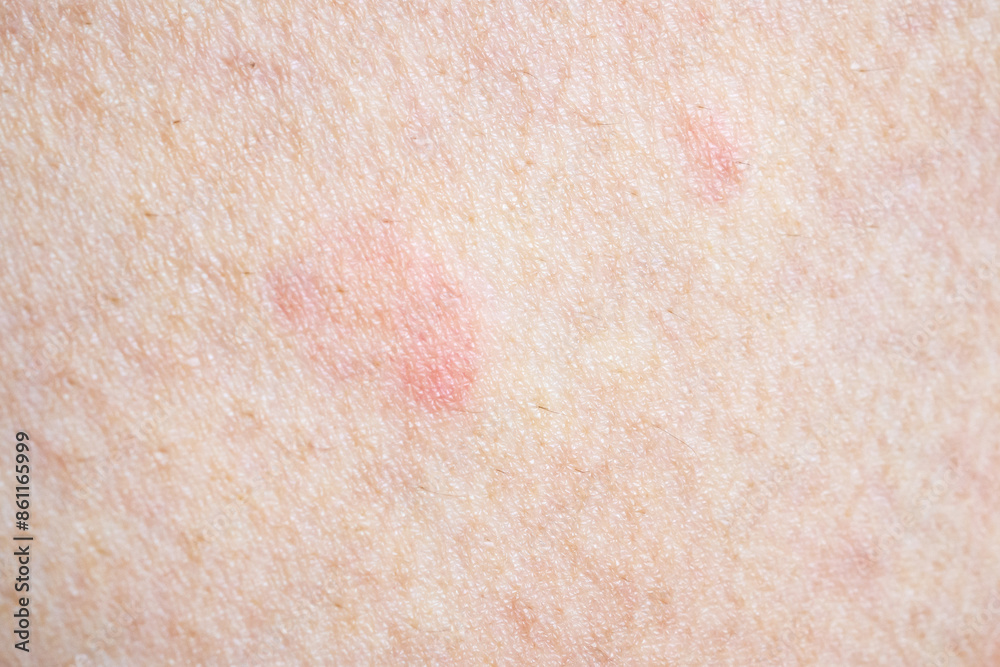 Fototapeta premium Skin allergy rash dermatitis texture close up