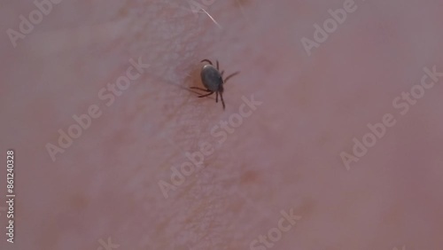 A tick on the skin that transmits dangerous diseases such as tick-borne encephalitis or Lyme disease.