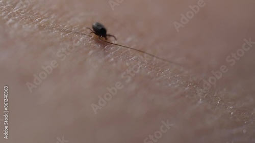 A tick on the skin that transmits dangerous diseases such as tick-borne encephalitis or Lyme disease.