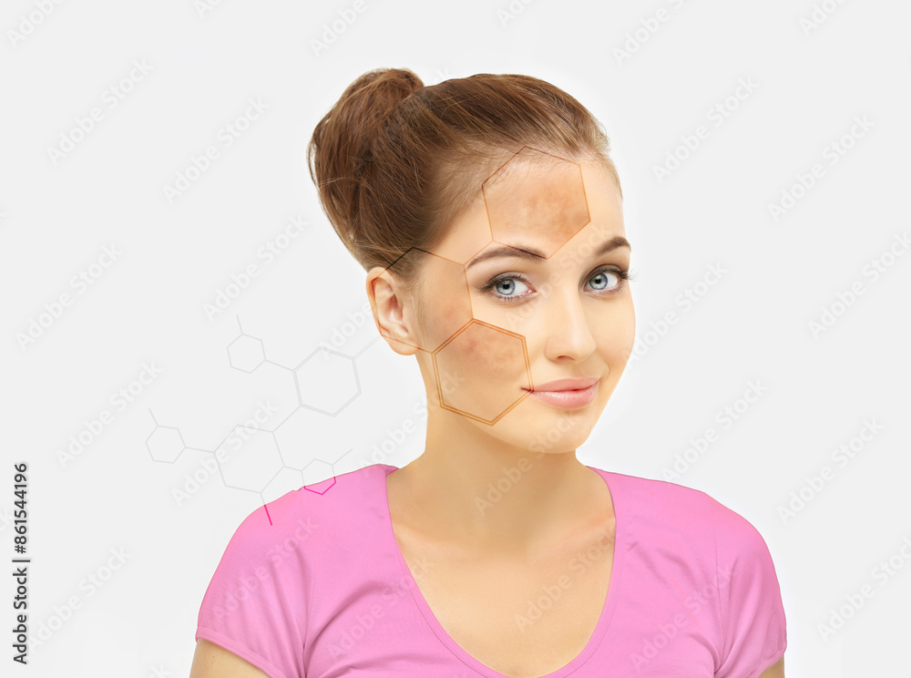 Fototapeta premium Dark spots, freckles,hyperpigmentation(melasma or chloasma),concept - skin lightening, skin whitening, fruit acids,AHA, Skin Brightening