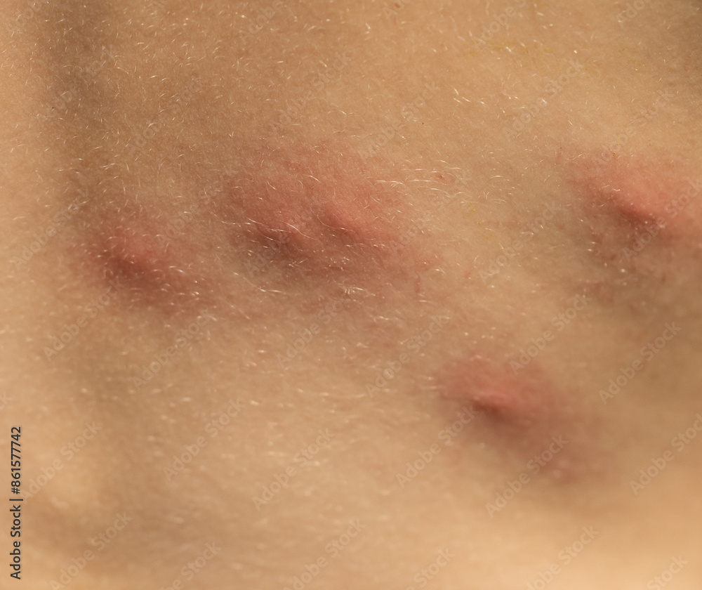 Fototapeta premium mosquito bites on a child's back as a background.