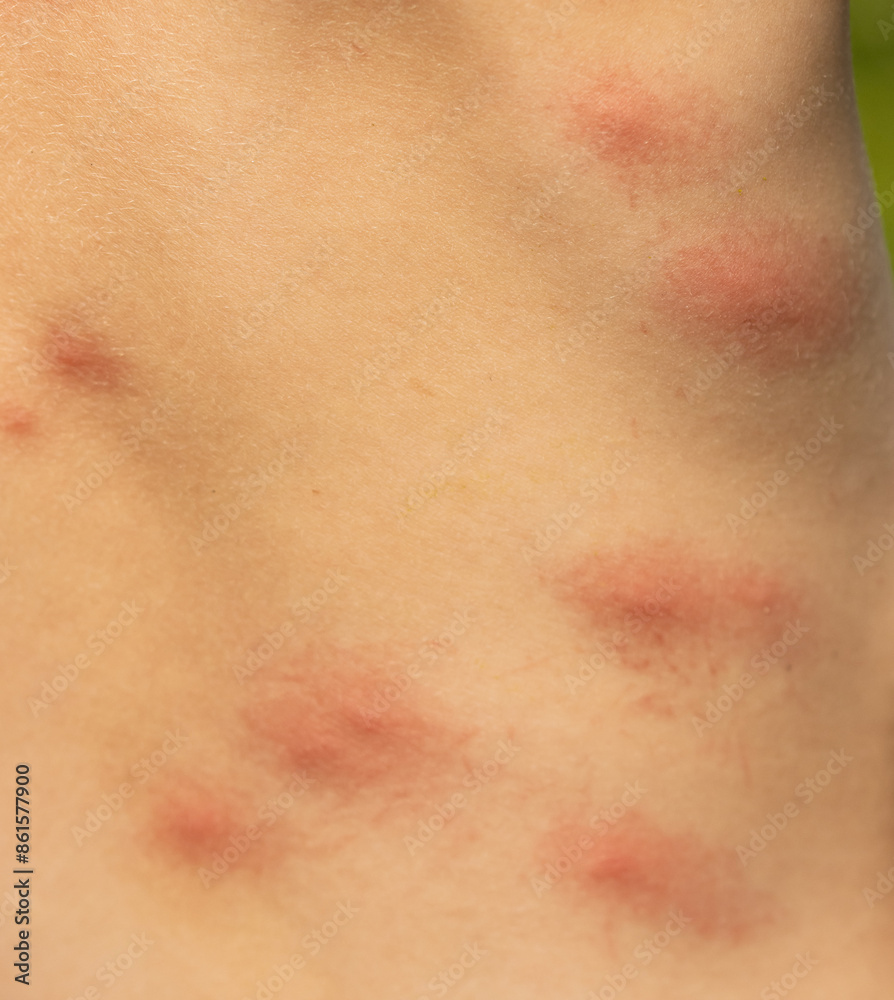 mosquito bites on a child's back as a background. mosquito bites on a child's back as a background.