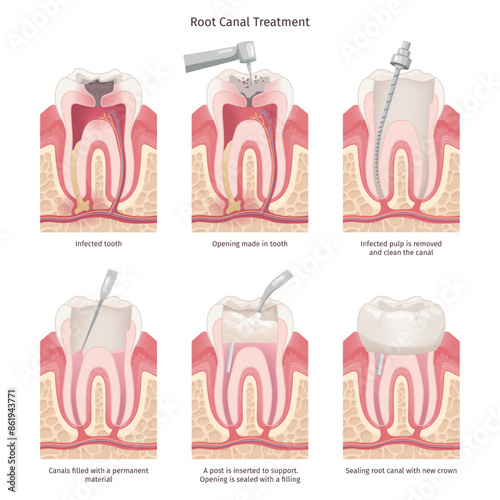 Root canal treatment. Tooth canal rooth filling endodontic procedure, roots bacteria infection dental caries treatment, maxillofacial gum anatomy diagram swanky illustration