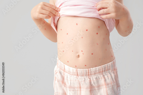 Fotografie Little girl ill with chickenpox on light background, closeup