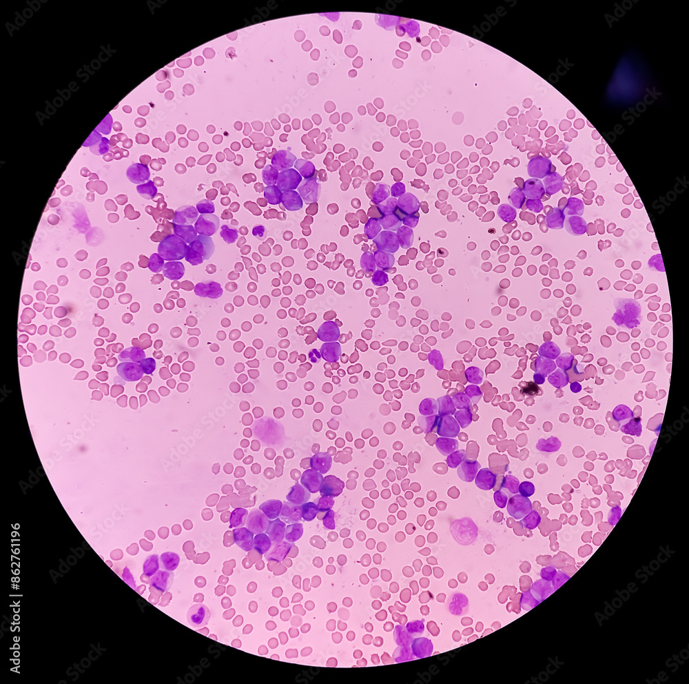 Acute myeloid leukemia (AML). Smear show monocytes and mostly blast ...