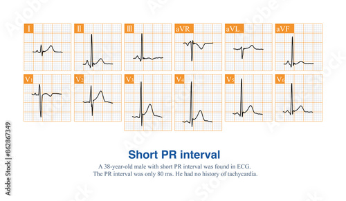 The PR interval of an adult ECG is less than 120 ms, which is called a short PR interval.