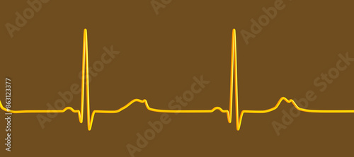 Long QT syndrome ECG, 2nd type, 3D illustration