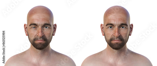 A man with Horner syndrome, 3D illustration