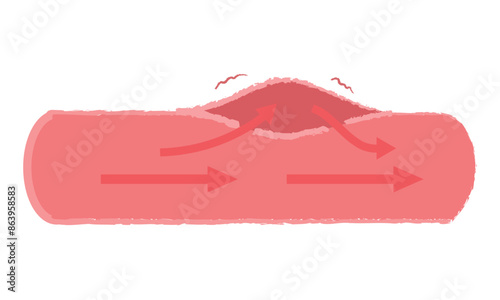 大動脈乖離の症状 血管断面図イラスト