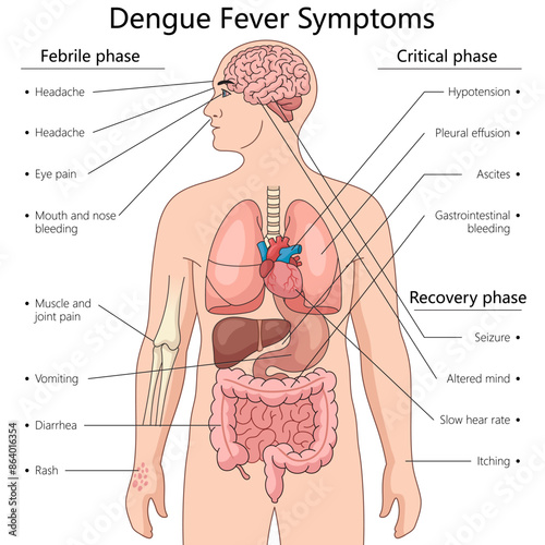 dengue fever across febrile, critical, and recovery phases, highlighting key areas affected in the human body diagram hand drawn schematic vector illustration. Medical science educational illustration