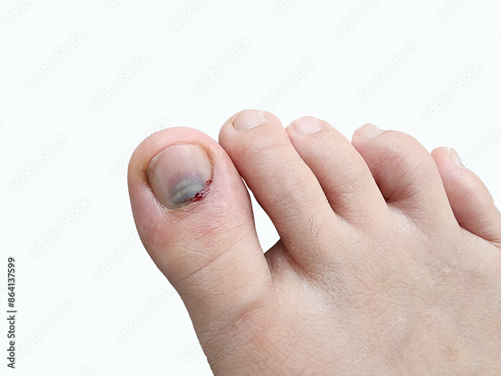 Subungual Hematoma is bleeding and bruising under the fingernails or toenails. It is usually caused by an injury, impact, or being hit by a falling object. Subungual Hematoma is bleeding and bruising under the fingernails or toenails. It is usually caused by an injury, impact, or being hit by a falling object.