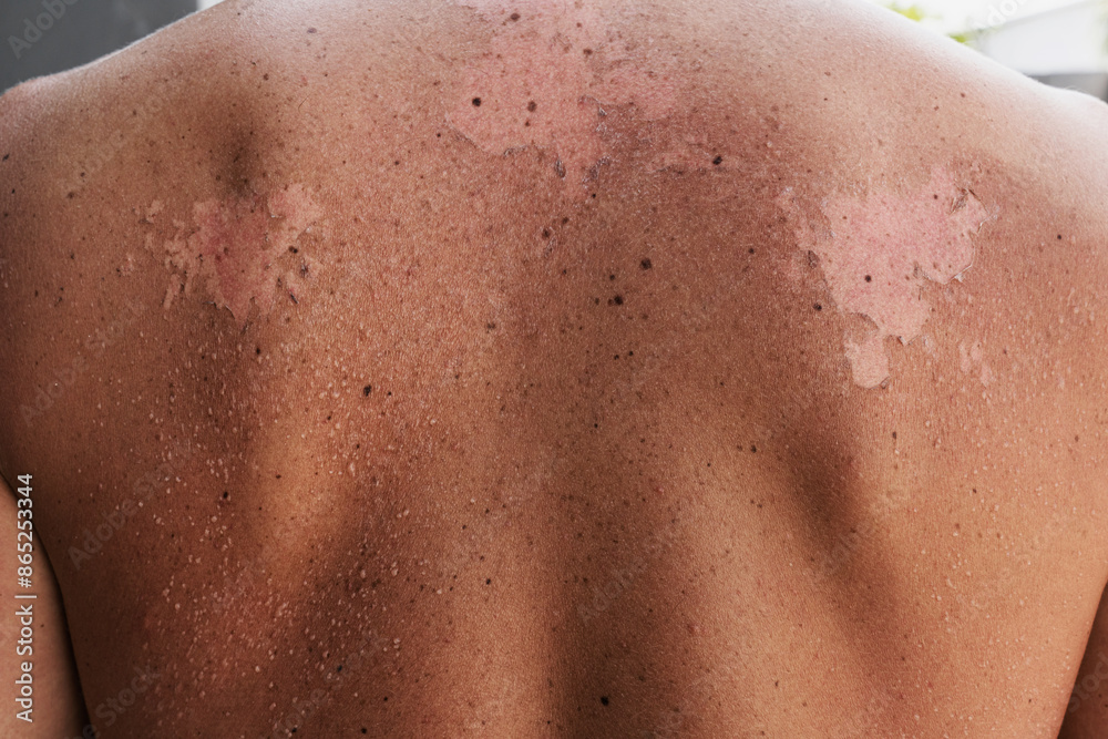 Close-up of a male back with peeling skin due to sunburn Close-up of a male back with peeling skin due to sunburn