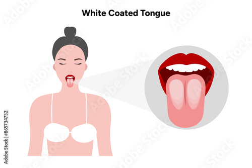 White coated tongue