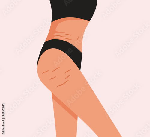 Stretch Marks on a Female Body Vector Illustration. Dermatology skin issue after postpartum period 
