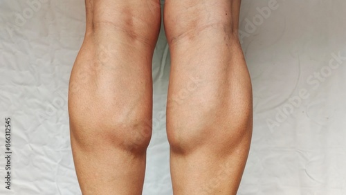 Quadro em tela close up the bulging and muscle, varicose veins spider, problem circulation of blood on the leg of the woman, health care and medical concept