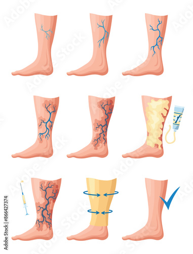 Stages or types of varicose veins development. Medical poster or disease infographic. Image of healthy and diseased legs. Vector illustration in flat style
