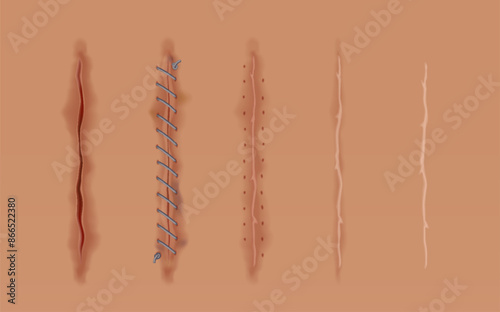 Obraz na płótnie Set of healing wounds, skin scars, stitched gash and cuts. Realistic surgical sutures, stitched wounds at different healing stages isolated on human skin background w salonie