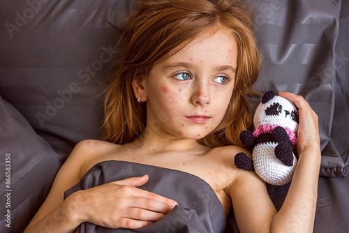 Little sad girl with a rash on her face and body lies in bed with a toy, chickenpox or measles virus in children