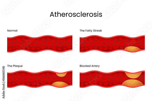 Stages of Atheroscleorosis. Normal Artery, The Fatty Streak, The Plaque and Blocked Artery