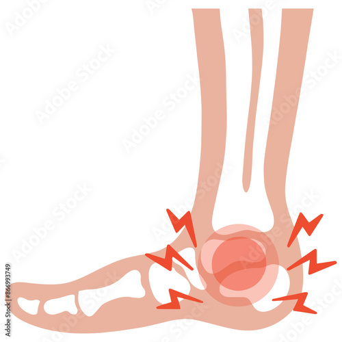 Vector rheumatoid arthritis foot joint icon simple vector illustration