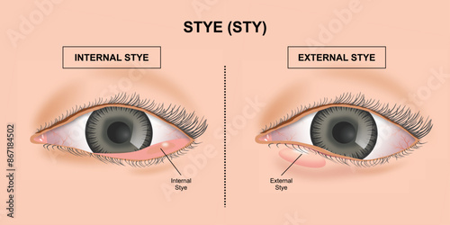Types of Stye (Sty) illustration