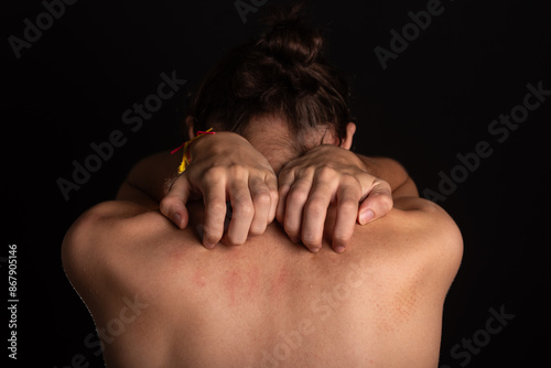 Young man, shirtless, scratching his back with his hands. Skin disease. Irritation, allergy. photo