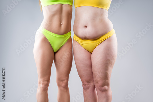 Before after weight loss, tummy tuck, fat and thin women with flabby and muscular bellies on gray background, plastic surgery and body positive concept photo