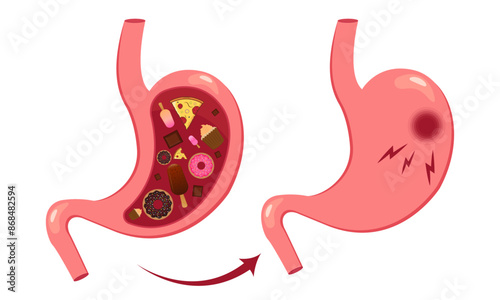 Stomach full of unhealthy food flat cartoon illustration. Overeating problem and stomach disease concept vector illustration.