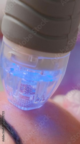 Procedure needle fractional RF for face lifting in a beauty clinic. Concept of beauty and cosmetology. Vertical video.