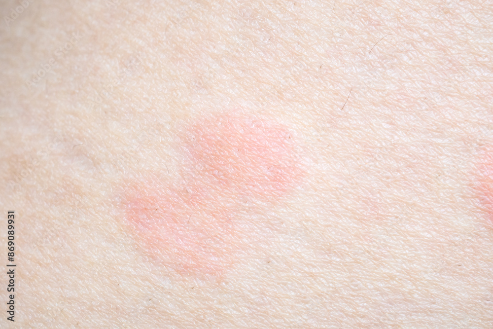 Skin allergy rash dermatitis texture close up