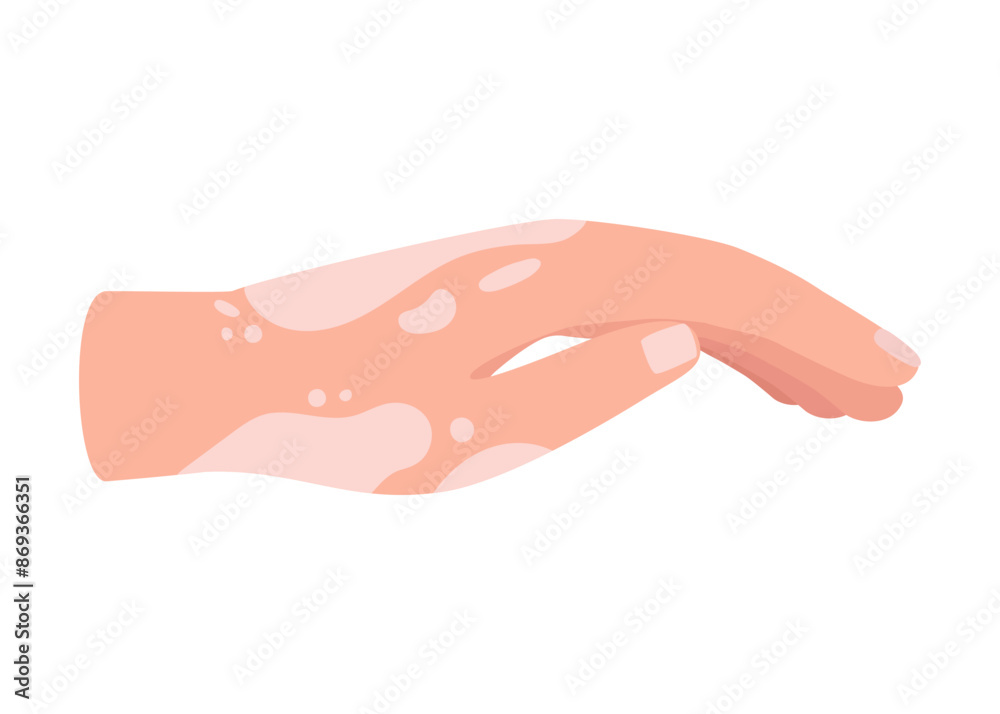 Vitiligo on skin of hand. Body with area pigmentation different color. Autoimmune disease. Vector Vitiligo on skin of hand. Body with area pigmentation different color. Autoimmune disease. Vector