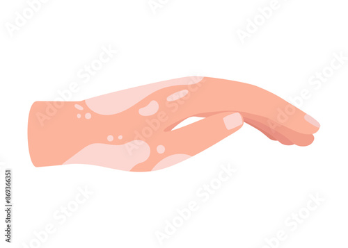 Vitiligo on skin of hand. Body with area pigmentation different color. Autoimmune disease. Vector
