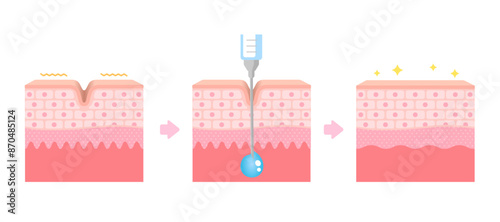 Mechanism of wrinkle improvement with botulinum toxin injection