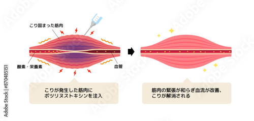 ボトックス注射 (ボツリヌストキシン）によるこりの緩和のメカニズム / ベクター図解イラスト