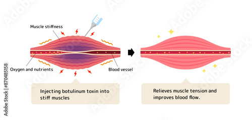 Mechanism of muscle relaxation by botulinum toxin injection