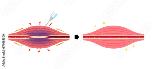 Mechanism of muscle relaxation by botulinum toxin injection